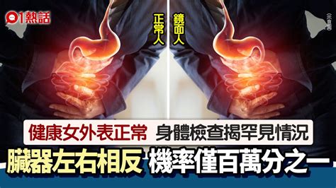 鏡面人原因|鏡面人│健康女做身體檢查 驚揭內臟器官左右相反 機。